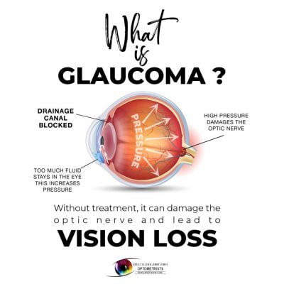 What is Glaucoma What is Glaucoma