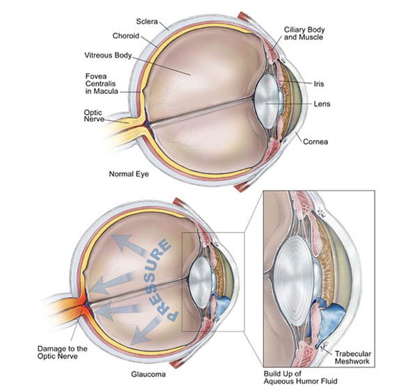 What is glaucoma What is glaucoma